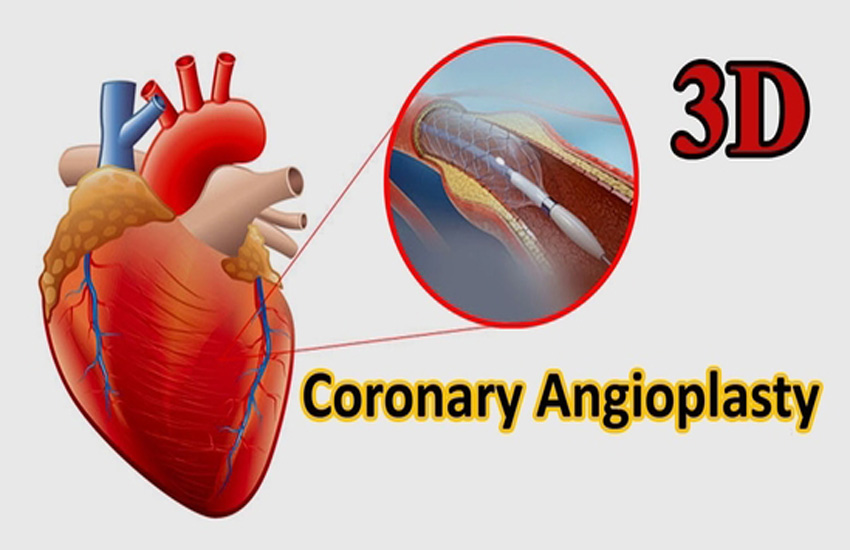 Angioplasty: A Minimally Invasive Route to Open Arteries