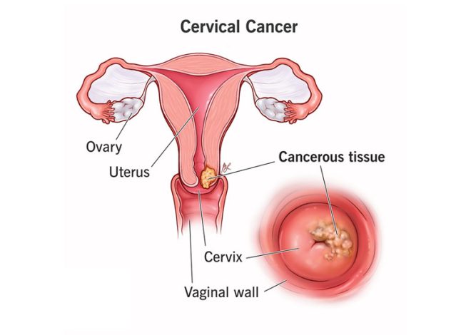 Understanding Cervical Cancer: Prevention, Detection, and Public Health Initiatives