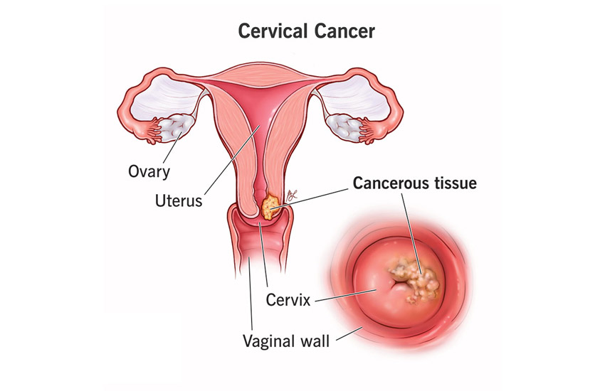 Cervical Cancer: A Preventable Threat